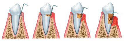 periodontitis-evolucion