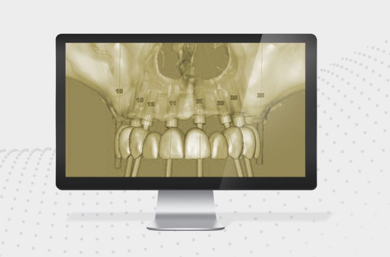 Implantología dental guiada por ordenador. Clínica Smilodon