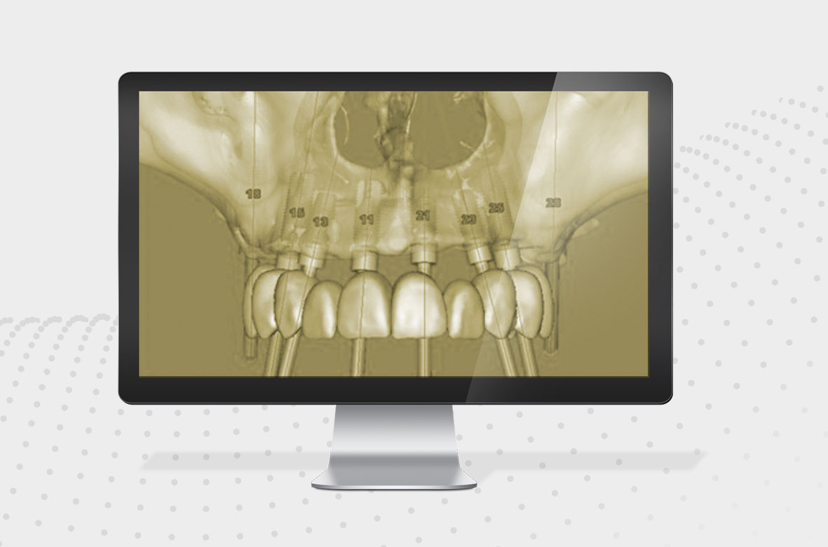 Implantología dental guiada por ordenador. Clínica Smilodon