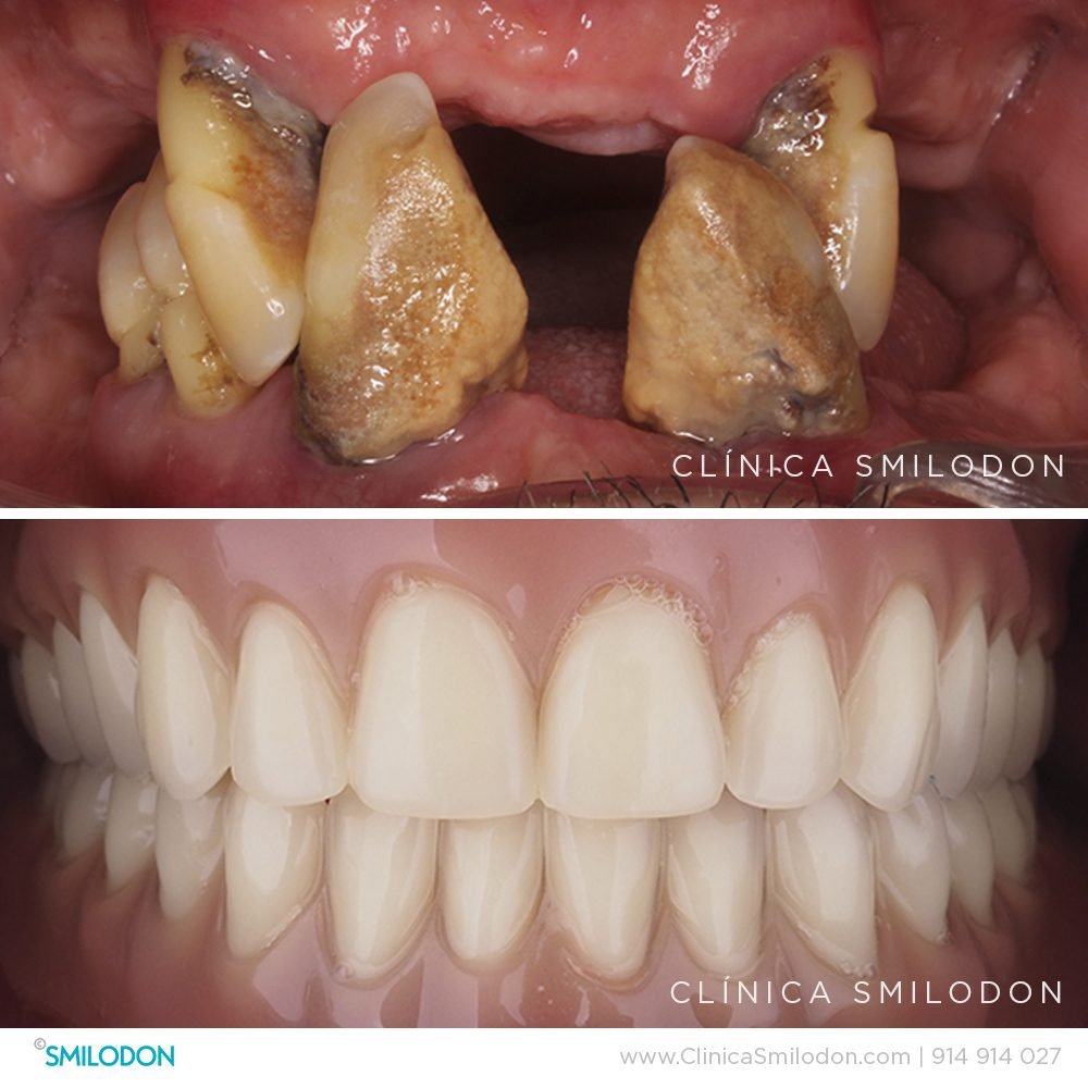 implantes-dentales-3