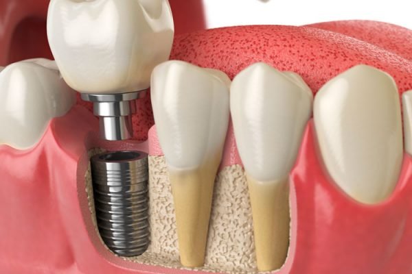 implante-dental-smilodon