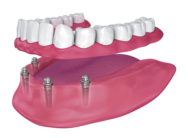 Cómo hacer limpieza de prótesis dentales correcta?
