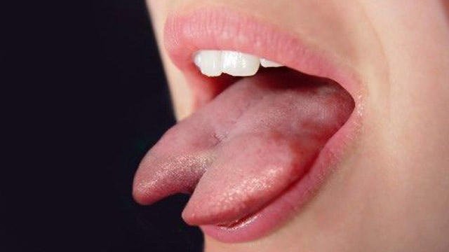 lengua bifida