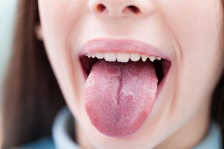Alteraciones en la lengua que alertan de problemas de salud