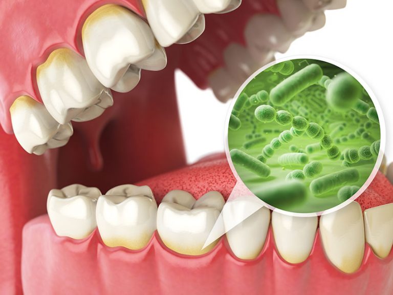 Todo sobre la halitosis. Clínica SMilodon
