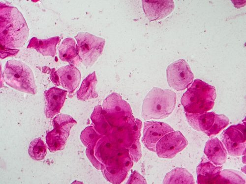 leucoplasia-oral