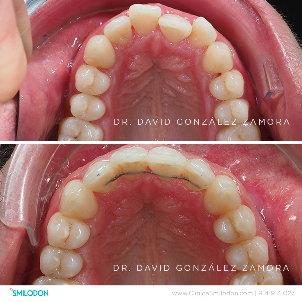 Tratamiento de ortodoncia con brackets: Urgencias y complicaciones más  comunes - Smileline Clinic