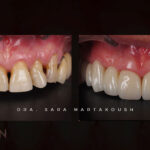 troneras-estetica dental