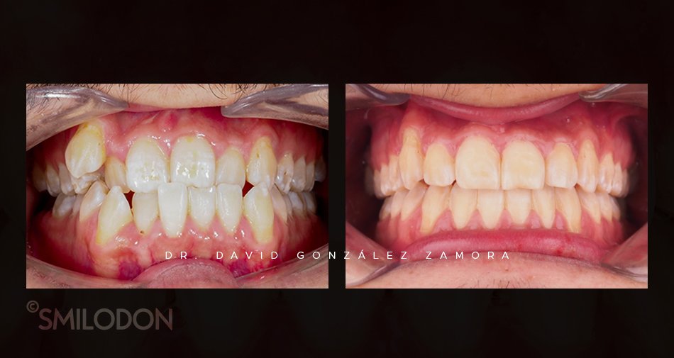caso clinico ortodoncia