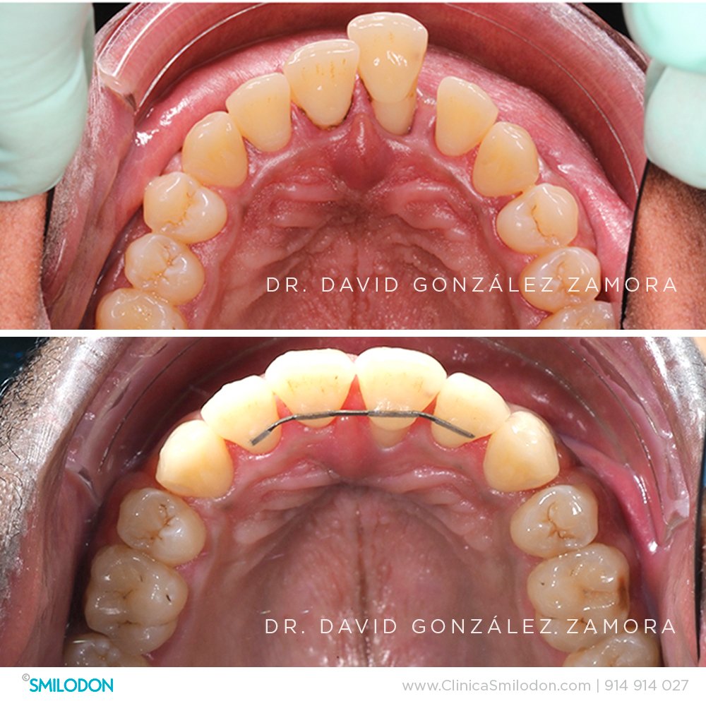 Tratamiento de ortodoncia con brackets: Urgencias y complicaciones más  comunes - Smileline Clinic