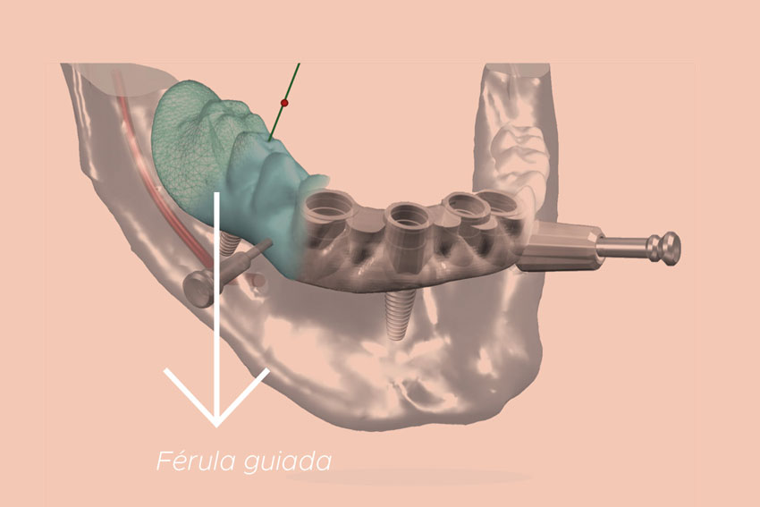 ferula-guiada