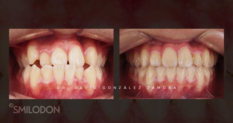 Clase III esquelética y dentaria con apiñamiento severo tratado en Clínica Smilodon