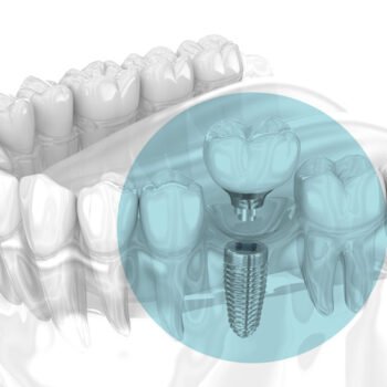 implante-dental