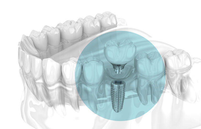 Fases del tratamiento con implantes dentales