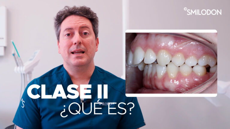 El Dr. González Zamora nos cuenta en el video qué es la Clase II, qué problemas de salud provoca y las novedades en su tratamiento. Clínica Smilodon