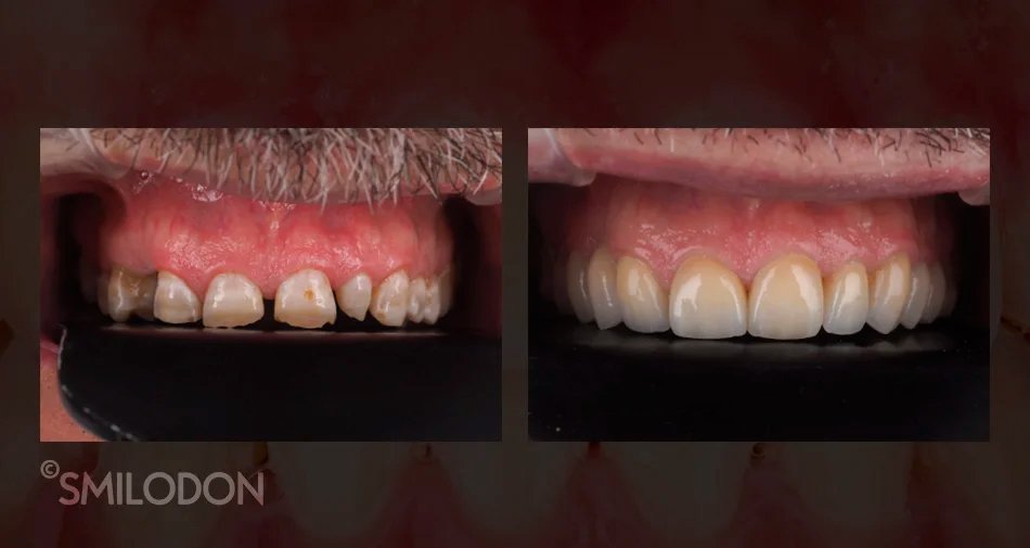 carillas dentales carillas dentales