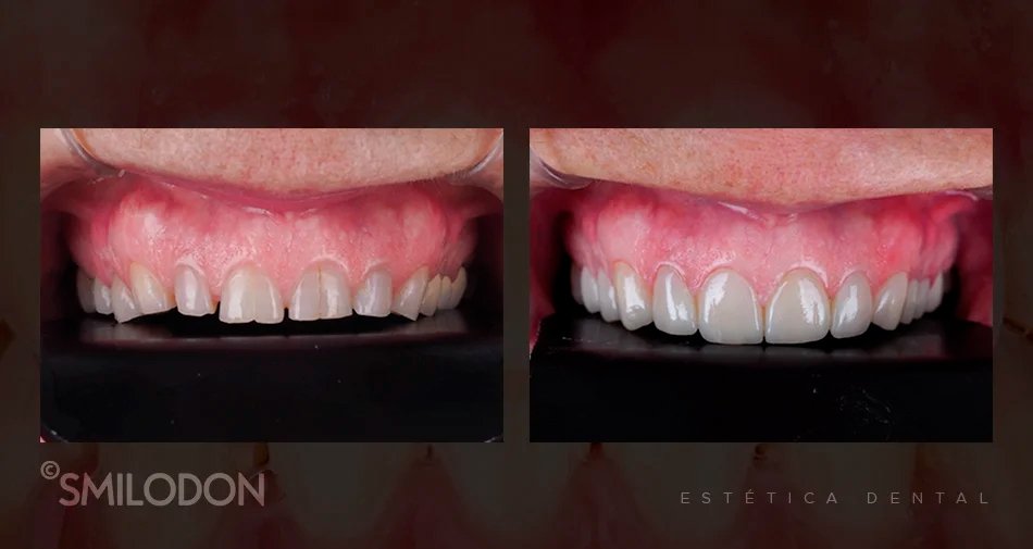 carillas dentales carillas dentales