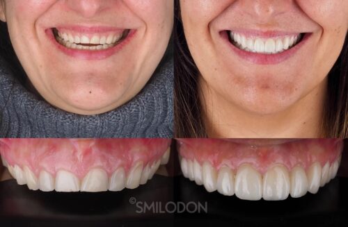 Carillas dentales antes y despues en Madrid centro