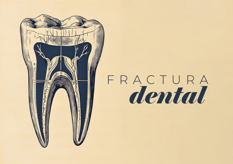fractura dental. Cínica Smilodon