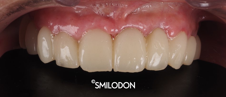 implantes-carga-inmediata