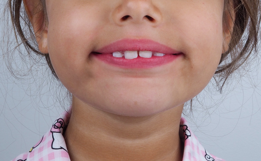 Ortodoncia-infantil-madrid