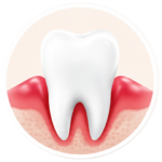 gingivitis